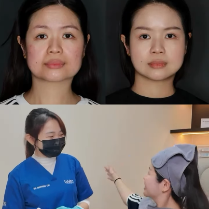 Profhilo Structura in Johor Bahru | Lyvin Clinic JB | Dr Kavin Certified Aesthetic Doctor